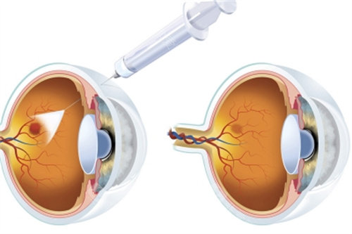 底黄斑病变打针收费明细指南：单次注射手术操作费约1000元、药物费（雷珠单抗/康柏西普）5000-5700元