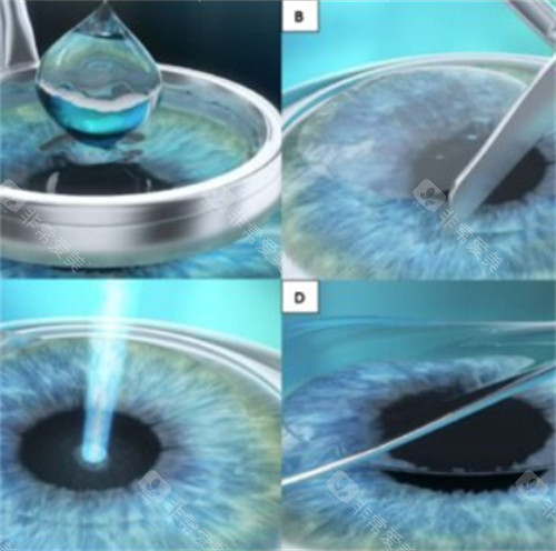 2026全新佛山市第二人民医院眼科价格表！检查/近视手术/配镜收费明细，两院区通用街坊收藏