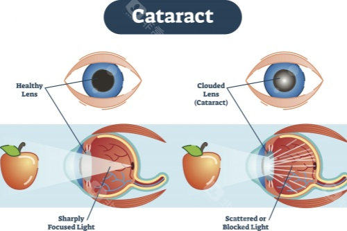 石家庄爱眼眼科医院和爱尔眼科医院哪个好？各有优势！爱眼眼科和爱尔眼科都是正规靠谱眼科医院！