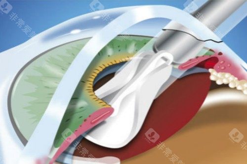 北京同仁眼科医院24小时问询电话+24小时免费在线询问：近视/白内障/斜弱视等问题在线询问预约挂号！