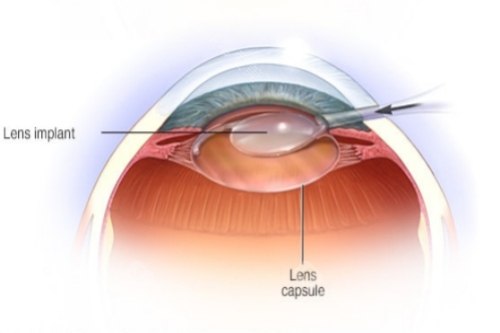 兰州白内障手术技术好的医院是哪几家？普瑞眼科、华厦眼科、爱尔眼科这三家是网友整理的排行榜医院！
