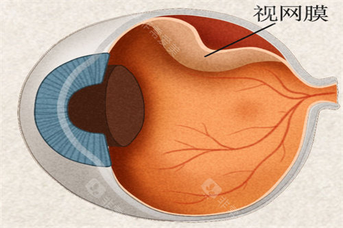 成人视网膜黄斑裂孔做手术多少钱？手术价格受多种因素影响，在线咨询获取个性化报价！