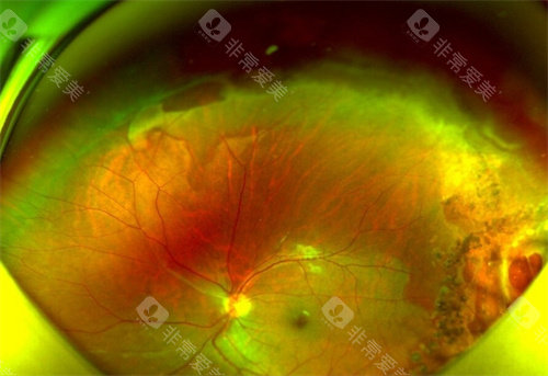 北京视网膜黄斑裂孔医院排名阿哪家好？参考这份网友整理的北京医院排名！