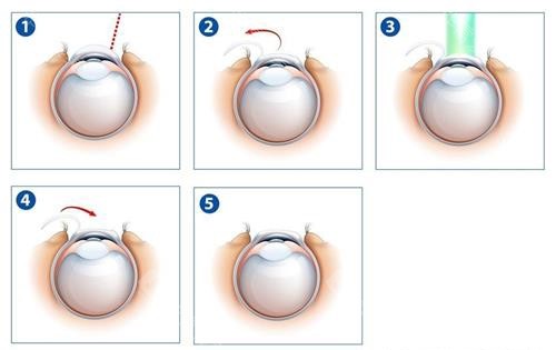 华西眼科医生排名精选：汇聚50余位硕博级医师，刘陇黔领衔眼视光学系，综合实力稳居国内前列