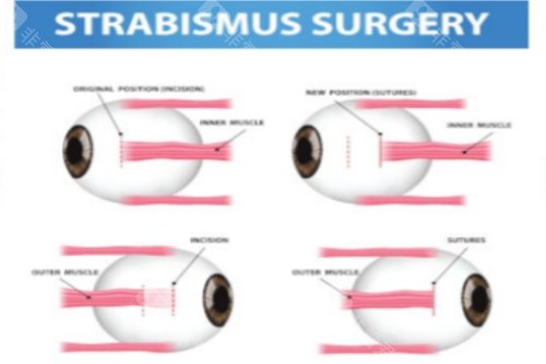 四川华西眼科刘陇黔怎么样啊？博士生导师、，擅长小儿斜视手术及视力防控。
