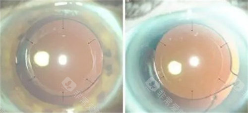 运城白内障手术免费政策详解，术前检查到基础晶体全免，2025年底前申请别错过，流程简单不跑腿