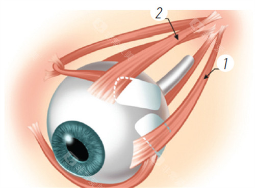 后巩膜加固术能保持终生吗？深度解析手术结果持续性，了解影响因素与应对策略