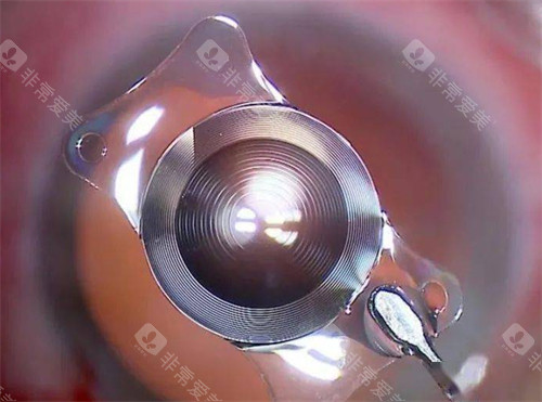 白内障单焦晶体十大排名有哪些？十大热门品牌全攻略，含技术亮点、价格区间及适用人群全解！