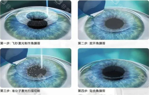 南京秦淮区半飞秒推荐：东南眼科12800元起，个性化方案定制！