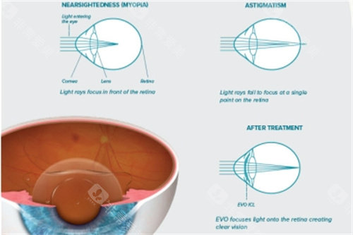南京ICL晶体植入哪家好？东南眼科15800元/单眼起，苏小璐医生亲诊！