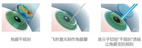 昆明全飞秒Pro多少钱？昆明华厦眼科梁刚医师主刀及2026活动详情!