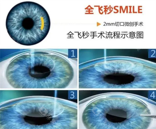 云南梁刚医师近视手术做得好吗？3万例手术经验+蔡司全飞秒设备解读