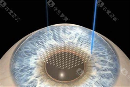 福州近视手术价格表查看，准分子激光8000元起/全飞秒15000元起/icl晶体植入29800元起！
