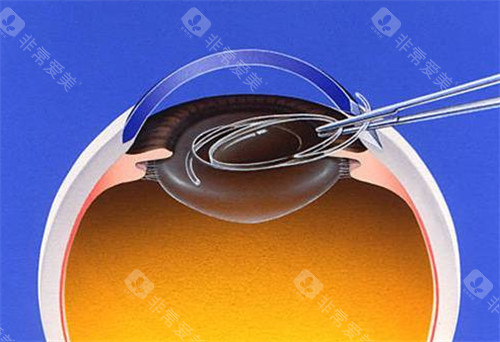 莆田白内障手术免费政策新规定，符合条件全免|申请流程简单|惠民活动超贴心！