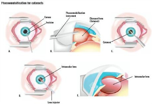 南华大学附属第一医院眼科白内障手术费用多少钱？费用构成拆解快看！