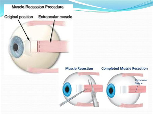 郑州斜视手术医院哪家好？郑州尖峰眼科精密矫正更靠谱，网友反馈结果自然获好评！