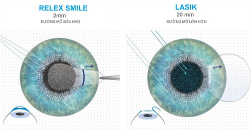 北京怀柔爱尔眼科好不好？超优质！青少年角膜塑形镜验配精密，成人屈光手术修养快，口碑爆棚