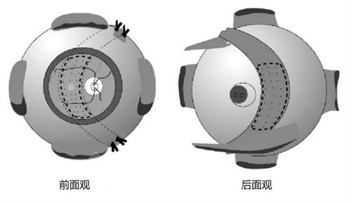 河南省立眼科医院后巩膜加固术多少钱？2026年材料不同收费有何差异，定价标准及核心影响点