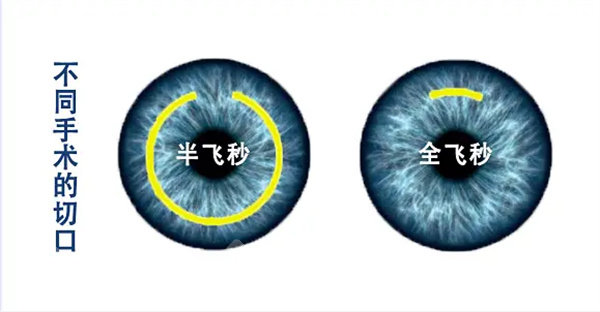 四川大学华西医院眼科口碑?超扎实!患者反馈