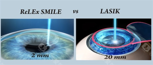 武汉做全飞秒近视手术靠谱医院整理！普瑞眼科、爱尔眼科和华厦眼科都是值得放心的眼科医院！