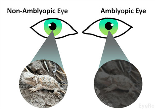 汕头儿童斜弱视治疗哪家好？慧晶眼科史汝娟/林小铭医师，诊疗有妙招！