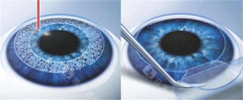 威沃眼科怎么预约挂号面诊？电话预约、官网预约、现场到院预约线上及线下预约方式分享！