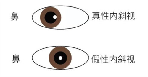 北京同仁儿童斜视眼科医生名单:付晶、艾立坤、傅涛、焦永红医生做斜视矫正手术技术好!