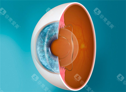 南京爱尔眼科医院哪个医生好?熊娟/赵世红技术PK，附近视/白内障患者真实术后反馈