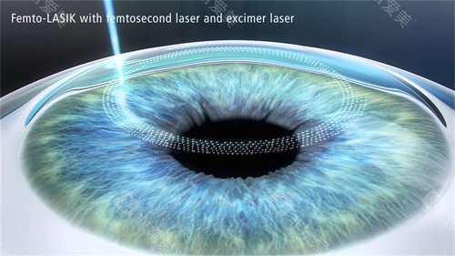 南京爱尔眼科医院做近视手术价格多少？全术式报价+省钱攻略倾情奉上