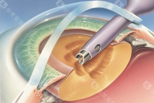 爱博诺德人工晶体治疗白内障怎么样？术后结果、费用及患者口碑全解析