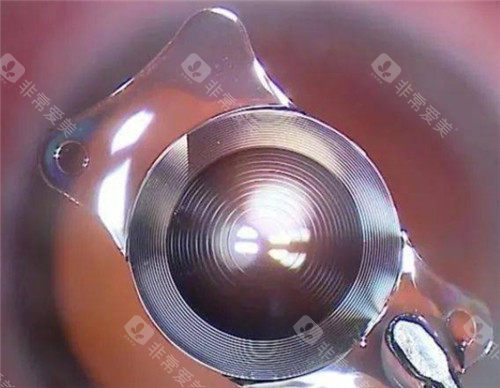 爱博诺德人工晶体a1-uv多少钱？单眼双眼报价+报销政策全解析