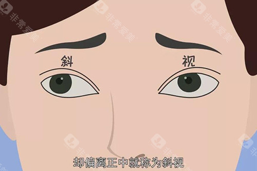 深圳斜视手术哪家医院好?爱尔眼科/佰视佳眼科/希玛林顺潮眼科/黑马眼科斜弱视矫正口碑好!