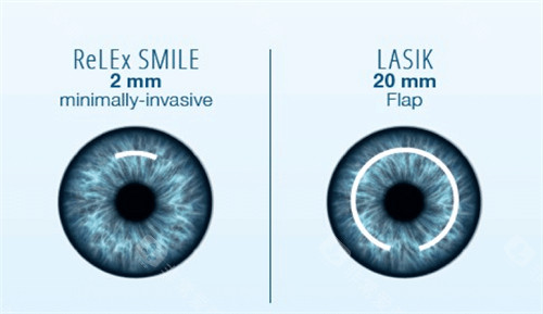 遵义医学院眼科近视手术价格表:半飞秒9980元起、全飞秒18000元起、ICL晶体植入3.2万元起