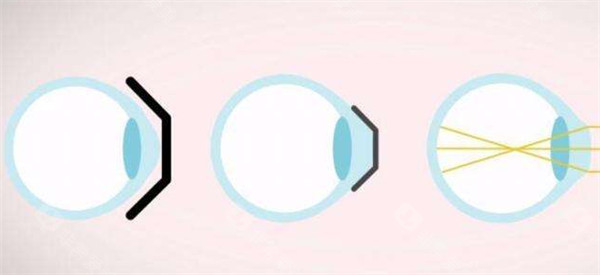 爱尔眼科医院飞秒激光多少钱？半飞秒、全飞秒价格大揭秘，为你清晰解读手术费用差异