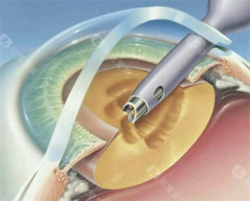 求美者亲测！湛江白内障技术好的医生排名榜，5位医生技术亮点全解析