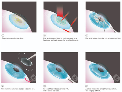 郑州近视眼手术医院排行大众推荐！郑州爱尔眼科、郑州尖峰眼科正规机构！