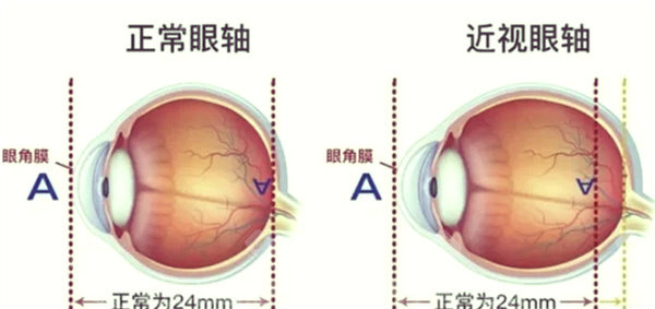 近视眼前后对比‘