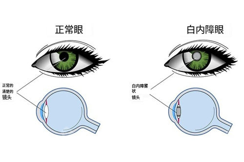 成都白内障手术免费申请流程：社区登记→术前检查→医院手术，年龄/户籍条件+材料清单全整理