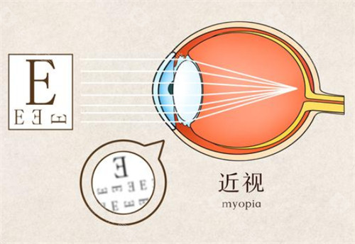 阿波罗新瞳学镜片防控成效怎么样?阿波罗新瞳学镜片有什么优点？价格多少钱一副? 近视眼手术 - 非常爱美